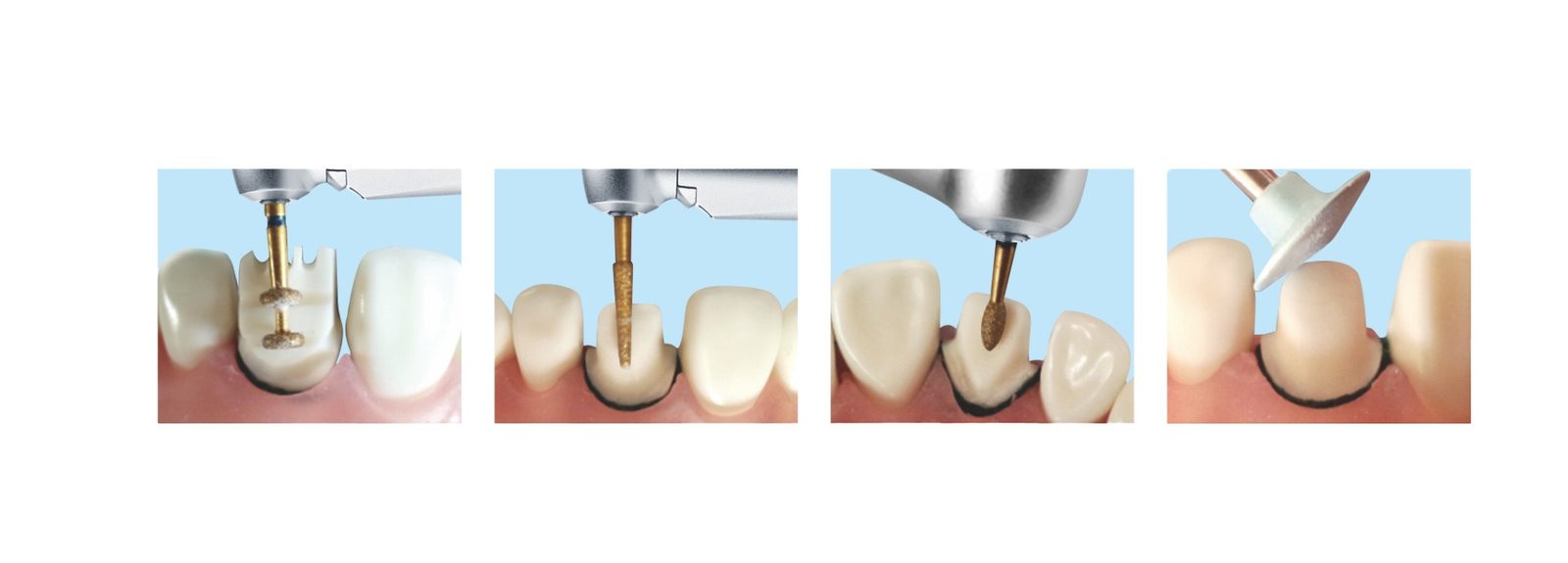 Restoration handpiece in dentistry treatment ranges