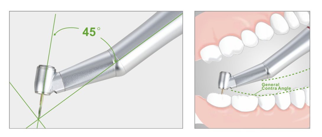 accessable to molar with 45 degree 1:5 speed increasing handpiece