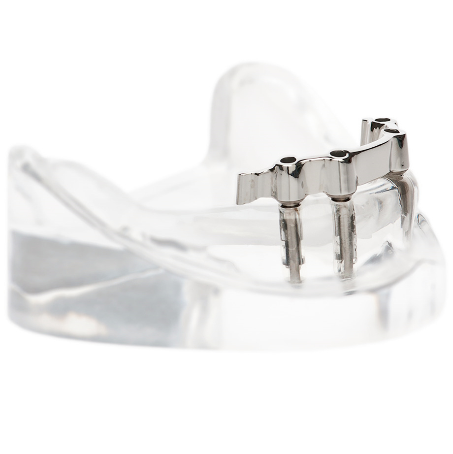 implant prosthesis titanium application